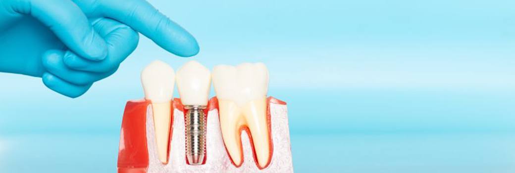 Dentist pointing to model of dental implants in Greensboro