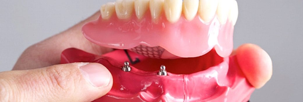 close up of hand holding a model of an implant-retained denture