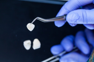 Close up of dentist examining porcelain veneers